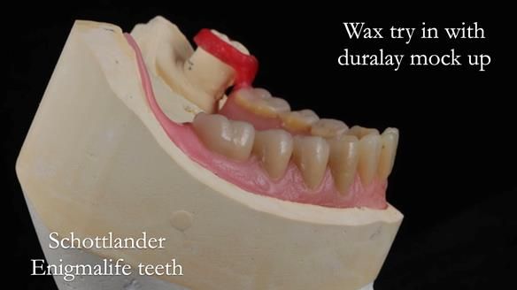 Finlay's Newsletter 59 Ultra hard partial dentures made for Gill