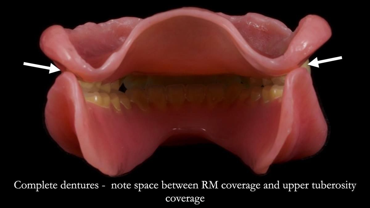 Fin’s Newsletter 88 — Complete dentures - full protocol… he rearranged his own teeth!
