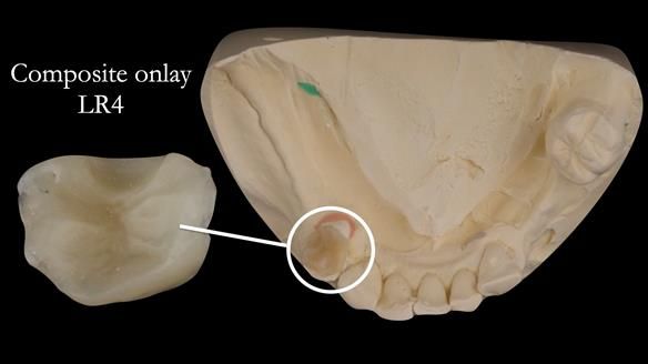 Eileen's transformation with upper and lower RPDs of Scandinavian hygienic design FULL PROTOCOL
