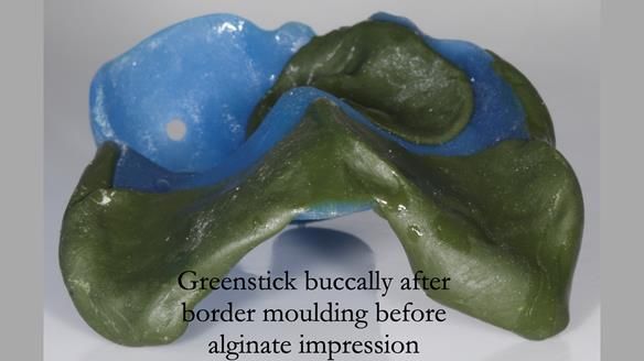 Newsletter 55 Provision of metal based partial dentures for Zephyrine with a repaired cleft lip and palate