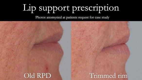 Newsletter 52 Managing Jo’s failing dentition with extractions and Mk 1/Mk 2 complete upper dentures and lower partial dentures FULL PROTOCOL