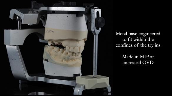 Finlay's Newsletter 60 Sylvia's upper Kennedy Class 2 Mod 1 metal based upper RPD