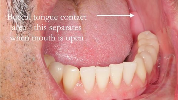 Finlay's Newsletter 62 provision of extractions and metal based complete dentures for Rafique