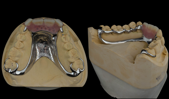 Figure 72 Finished definitive partial dentures. Scandinavian design - keeping the denture components 3mm away from the gingival margin