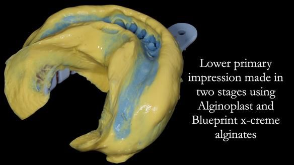 Newsletter 52 Managing Jo’s failing dentition with extractions and Mk 1/Mk 2 complete upper dentures and lower partial dentures FULL PROTOCOL