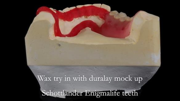 Finlay's Newsletter 61 provision of a lower unilateral free end saddle metal based partial denture for Joyce