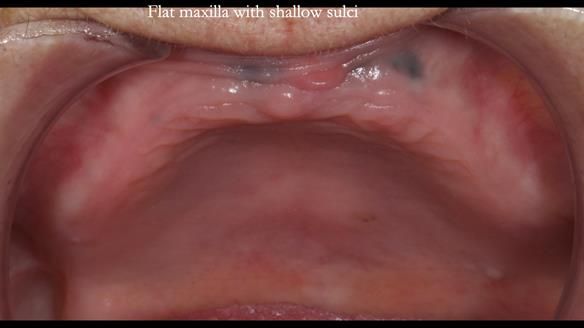 Newsletter 83: Sheila’s Complete Denture Success