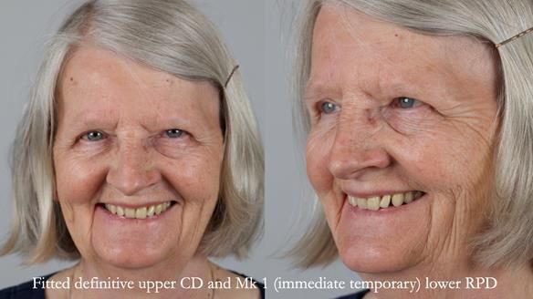 Newsletter 82 Mary - A complete upper and a one-tooth gasket denture