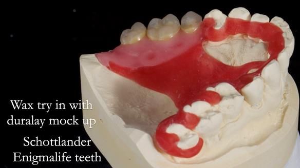 Finlay's Newsletter 64 case study - provision of a Kennedy class 2 metal based Scandinavian RPD for Ian