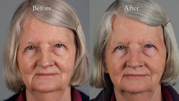 Newsletter 82 Mary - A complete upper and a one-tooth gasket denture