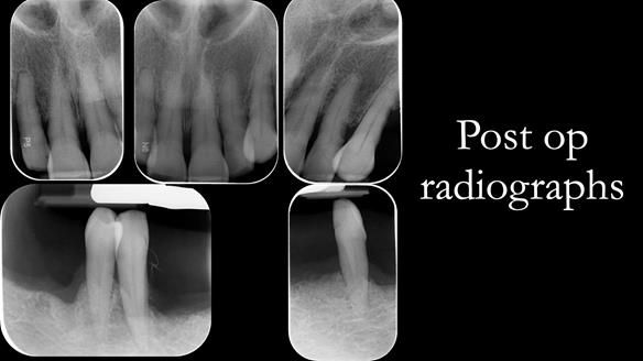 Finlay's Case Study Newsletter 40 - Immediate Mk 1 RPD to Definitive Mk 2 RPD - full protocol