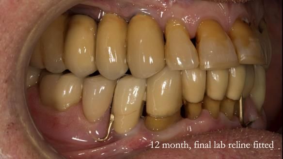 Ken – going downhill, first class