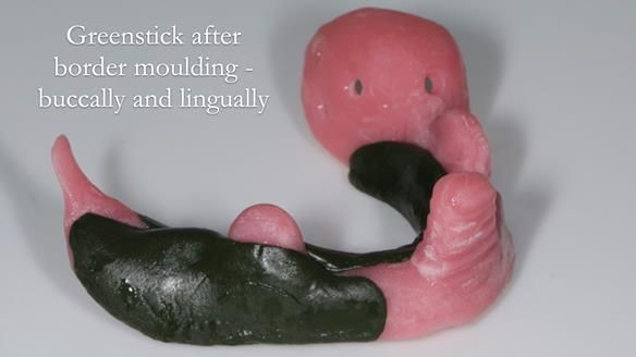 Finlay's Newsletter 59 Ultra hard partial dentures made for Gill