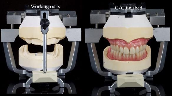 Newsletter 78: What do Clark Gable and a Locator® overdenture have in common?