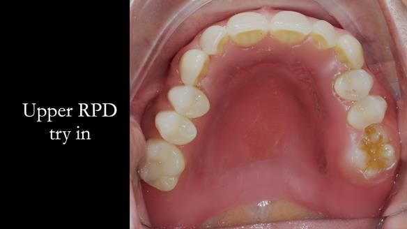 Finlay's Newsletter 58 Gasket upper partial denture for Zoe