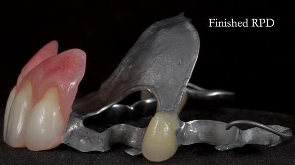 Newsletter 81 - Pam’s Story — how a partial denture changed her life (+ live walkthrough this Thursday)