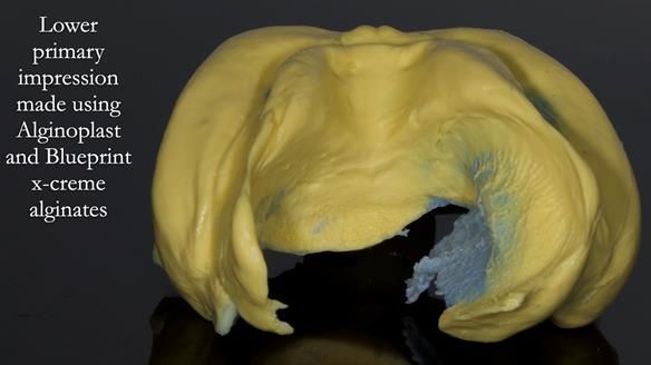 Newsletter 83: Sheila’s Complete Denture Success