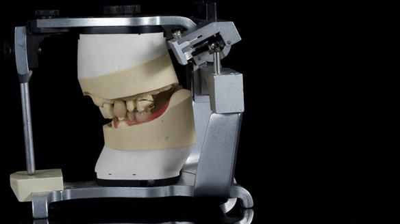 Newsletter 86 Peter the Architect — precision removable partial dentures case study