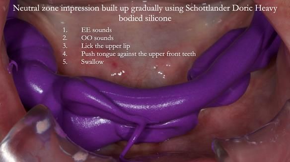Newsletter 83: Sheila’s Complete Denture Success