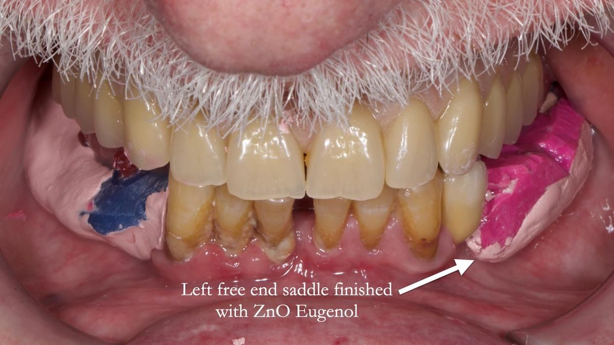 Newsletter 87 – Father Peter: A Partial Denture that needed Minor Miracle