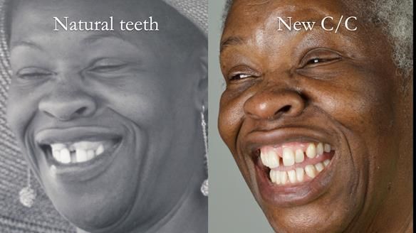 Newsletter 53 showing the making and fitting of ultra life-like dentures for Valena