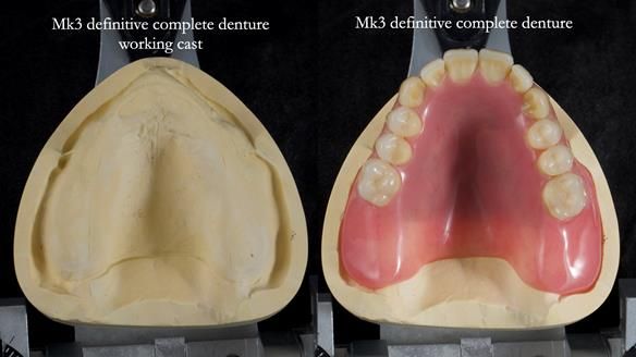 Newsletter 77: Jeremy’s case – immediate complete upper denture