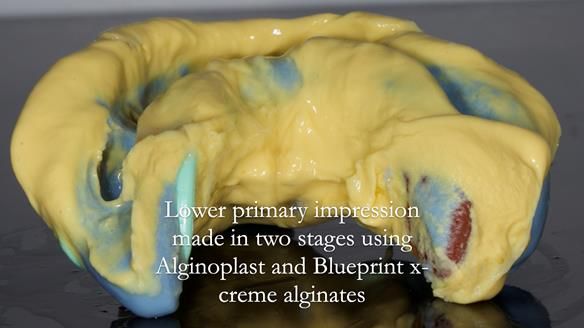 Newsletter 55 Provision of metal based partial dentures for Zephyrine with a repaired cleft lip and palate