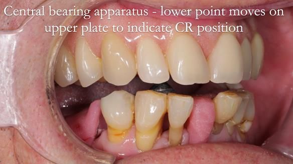 Newsletter 54 case presentation upper complete denture and lower Scandinavian designed hygienic partial denture for David