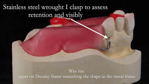 Finlay's Newsletter 60 Sylvia's upper Kennedy Class 2 Mod 1 metal based upper RPD
