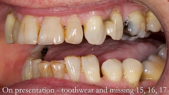 Finlay's Newsletter 64 case study - provision of a Kennedy class 2 metal based Scandinavian RPD for Ian