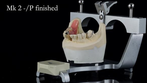 Newsletter 54 case presentation upper complete denture and lower Scandinavian designed hygienic partial denture for David
