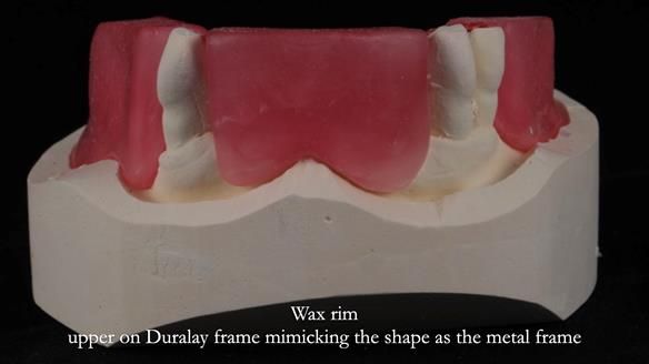 Finlay's Newsletter 59 Ultra hard partial dentures made for Gill