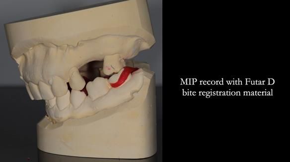 Finlay's Newsletter 61 provision of a lower unilateral free end saddle metal based partial denture for Joyce