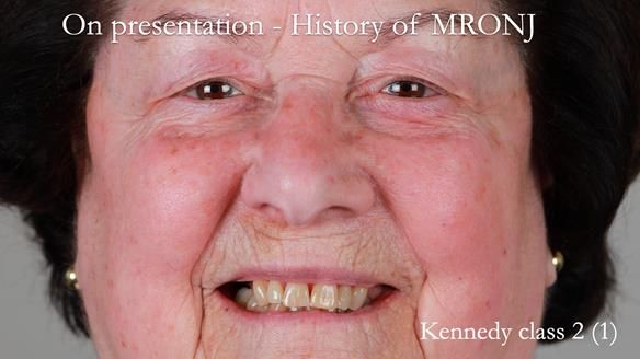 Finlay's Newsletter 60 Sylvia's upper Kennedy Class 2 Mod 1 metal based upper RPD