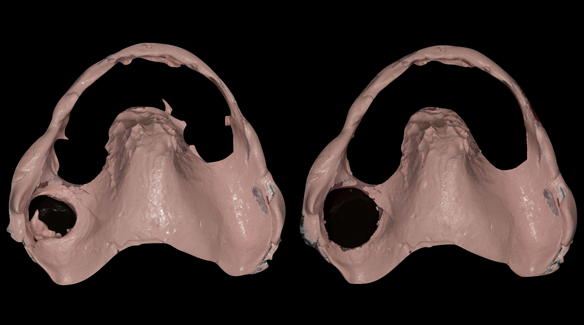 Figure 17 Definitive impression - zinc oxide and eugenol. Left - prior to cleaning window with blade - right after cleaning window with blade