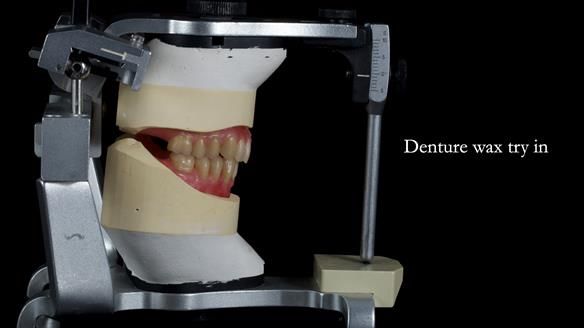 Newsletter 83: Sheila’s Complete Denture Success