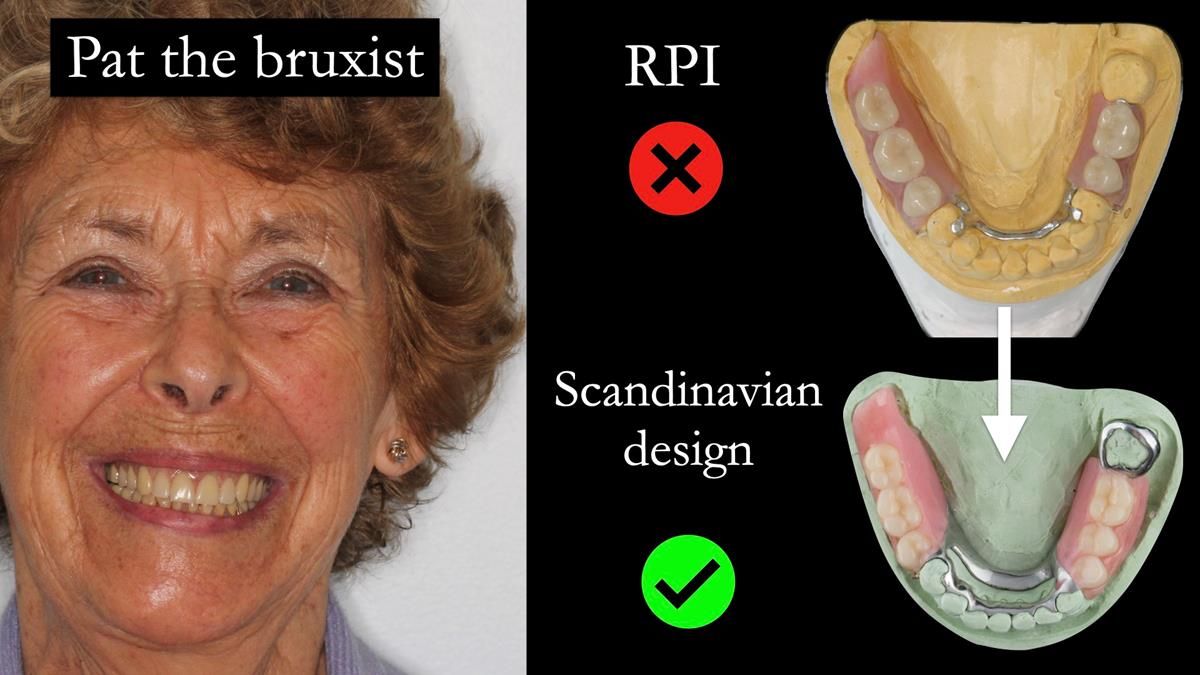 Newsletter 87 – Father Peter: A Partial Denture that needed Minor Miracle