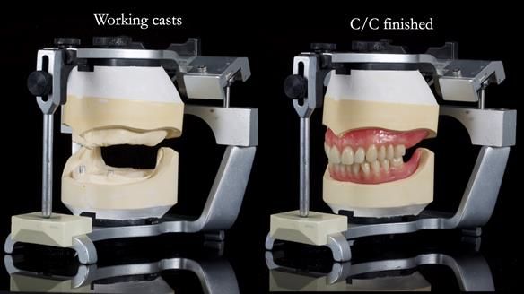 Newsletter 78: What do Clark Gable and a Locator® overdenture have in common?