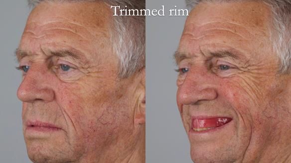 Newsletter 54 case presentation upper complete denture and lower Scandinavian designed hygienic partial denture for David