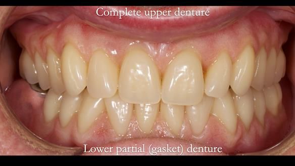 Newsletter 82 Mary - A complete upper and a one-tooth gasket denture