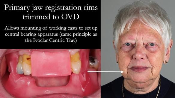 Finlay's Newsletter 59 Ultra hard partial dentures made for Gill