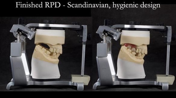 Solving Sue's failed implants with metal based RPD - full protocol Newsletter 43