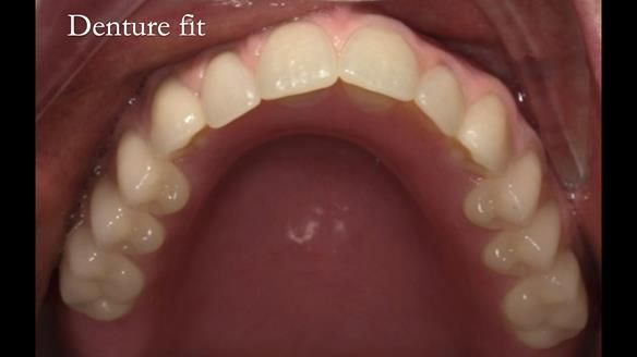 Newsletter 75: Marion’s case - Step-by-step complete denture workflow