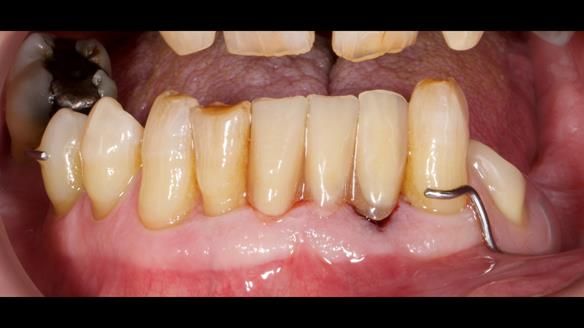 Newsletter 86 Peter the Architect — precision removable partial dentures case study