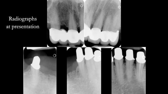 Newsletter 76: Jackie’s case – Telescopic overdenture & precision RPD (the tricky truth!)