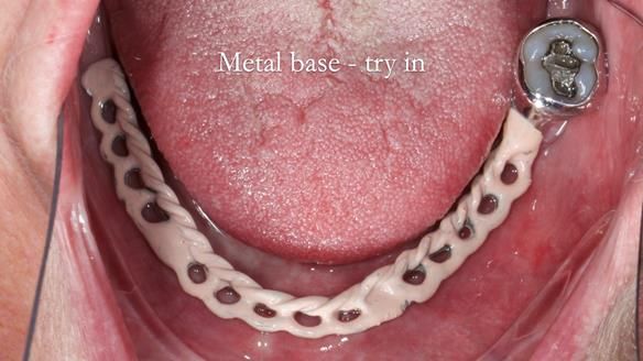 Finlay's Newsletter 59 Ultra hard partial dentures made for Gill