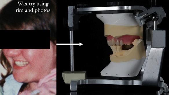 Finlay's Newsletter 58 Gasket upper partial denture for Zoe