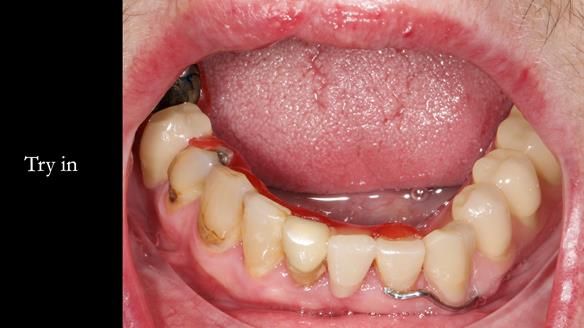 Newsletter 55 Provision of metal based partial dentures for Zephyrine with a repaired cleft lip and palate