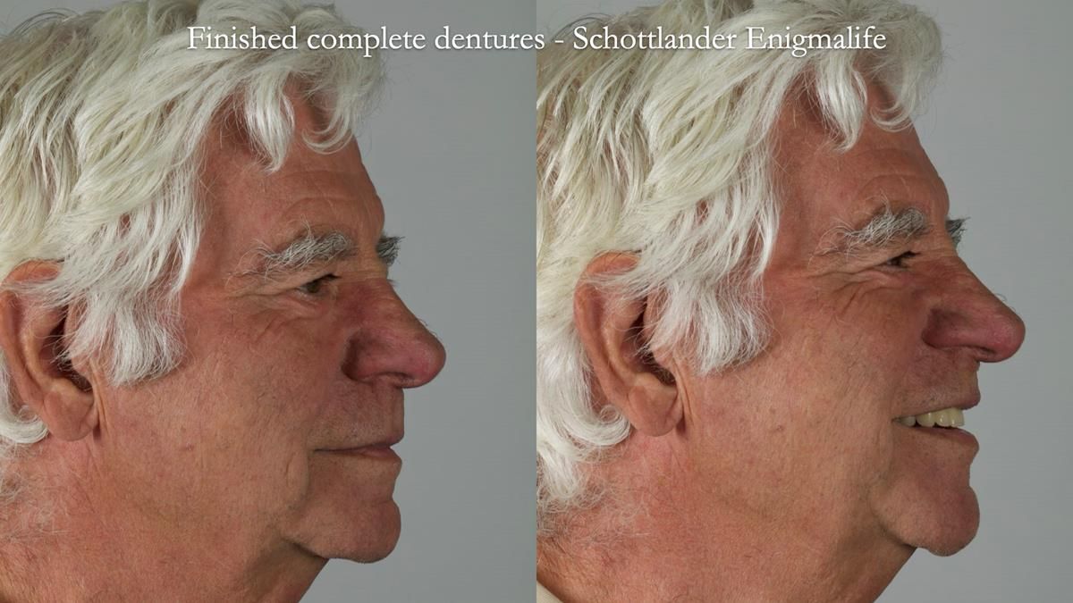 Fin’s Newsletter 88 — Complete dentures - full protocol… he rearranged his own teeth!