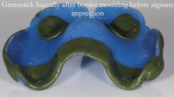 Newsletter 53 showing the making and fitting of ultra life-like dentures for Valena